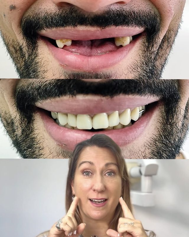 Reel: antes y después de una rehabilitación — sonrisa restaurada en DentalUP